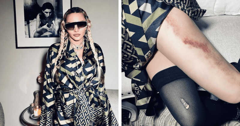 'Life has beaten me up!': Madonna shows off painful bruising in wild snaps