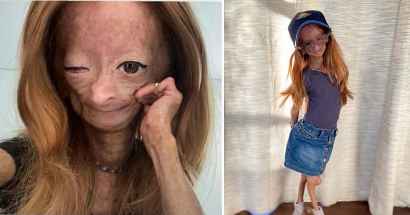 Adalia Rose Williams: YouTuber with Benjamin Button syndrome BRUTALLY trolled before death at 15