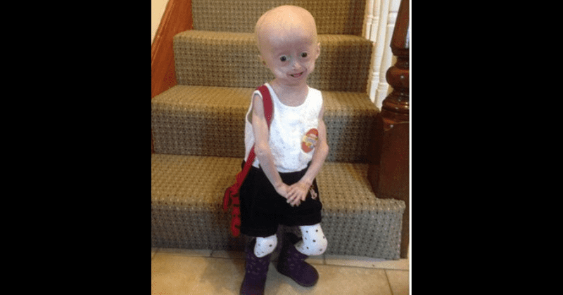 Girl who aged eight times times faster than her friends dies at the tender age of 8